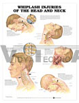 Whiplash Injuries of the Head and Neck Anatomical Chart